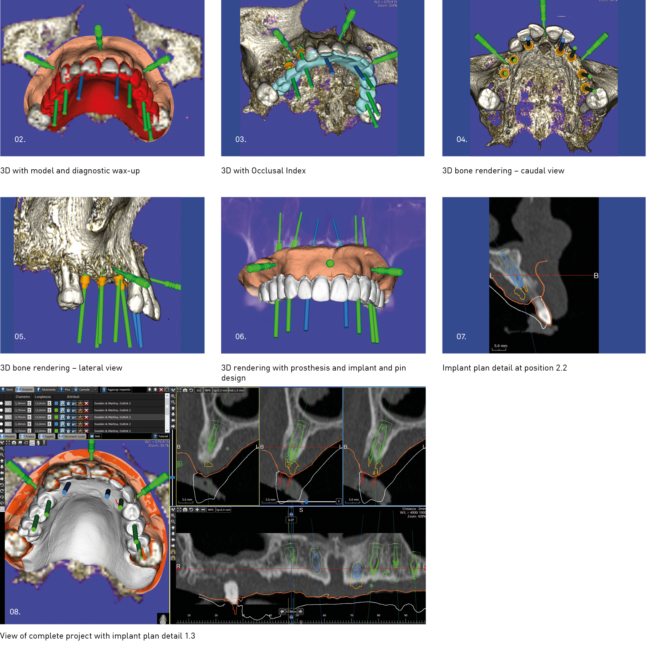 Computer-aided Implant Surgery In Superior Maxillar With