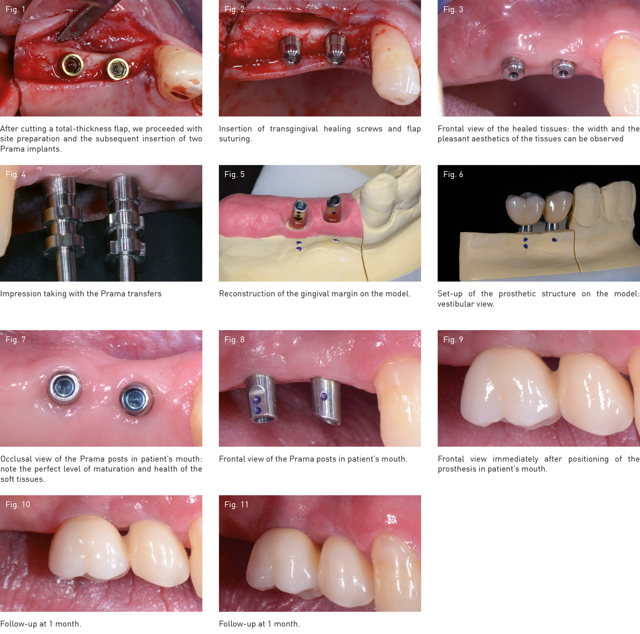 Implantoprosthetic Rehabilitation Of A Distal Bridge With Prama
