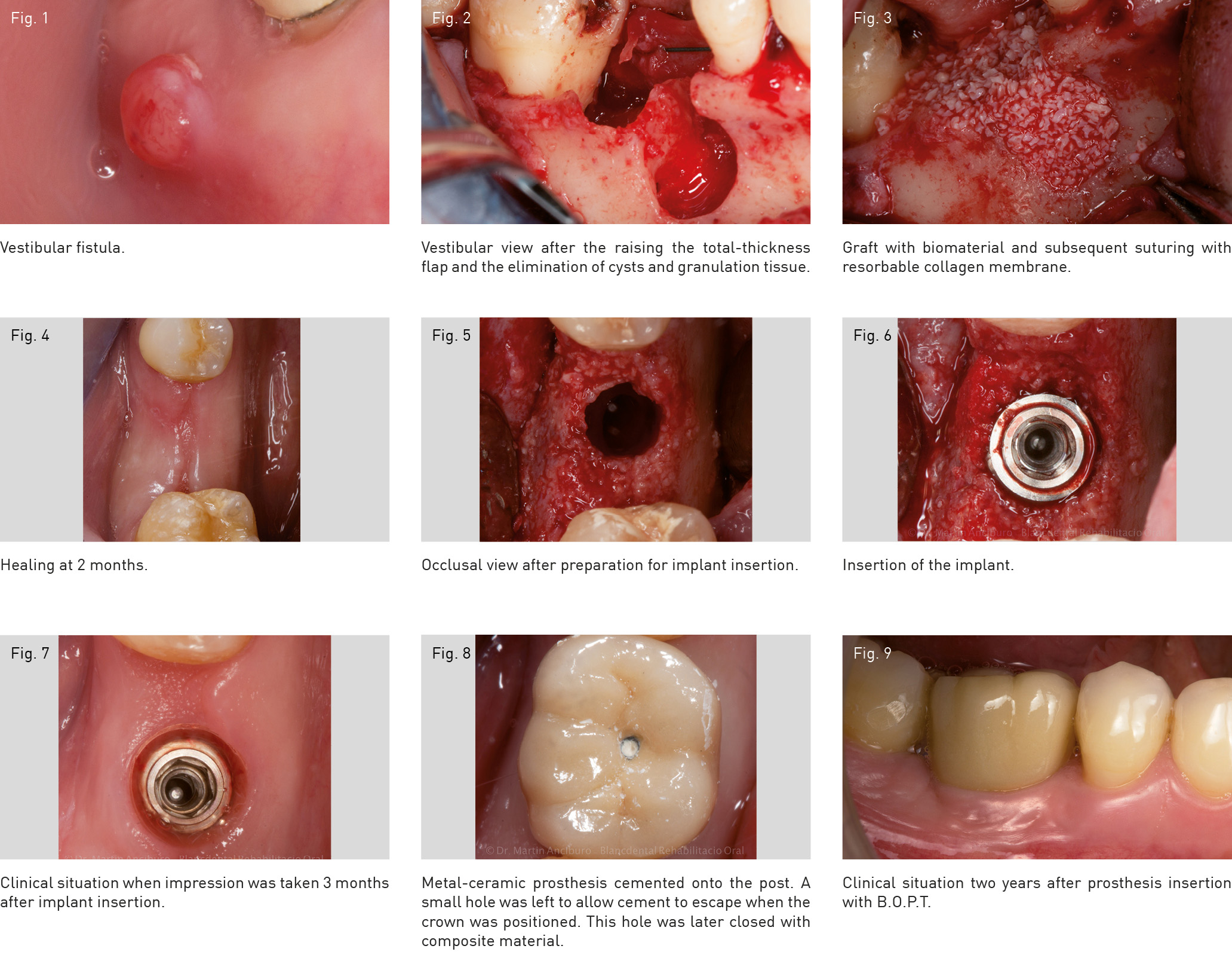 Singleunit Implant Supported Rehabilitation Using The Biologically Oriented Preparation