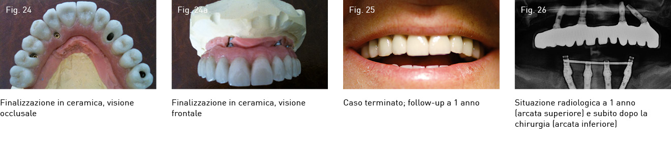 Ortodonzia Invisibile - Centri Implantologici Tramonte