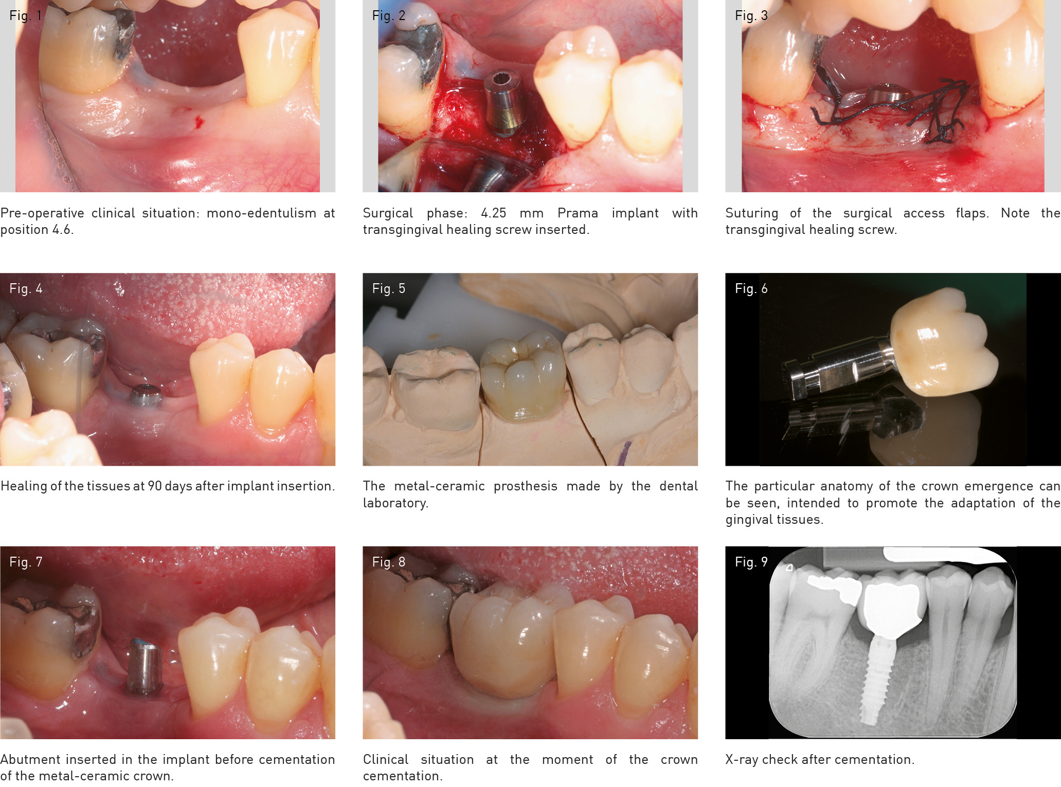 Rehabilitation Of A Single Element In Position 4.6 With A Prama Implant